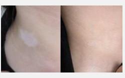 308治疗颈部白癜风效果怎么样