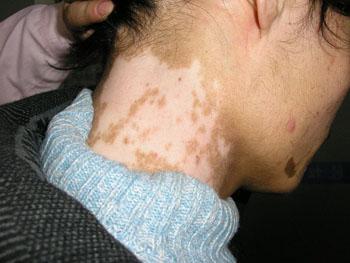 ¾±²¿°×ñ°·ç³¤ÆÚ±»ÕڸǻáÓÐÄÄЩΣº¦