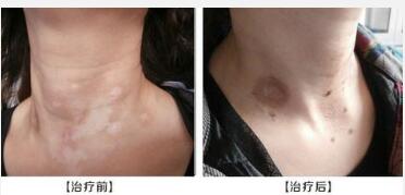 颈部白癜风患者在饮食上需要注意哪些护理方法