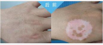 黑色素移植法治疗肢端型白癜风需要多久
