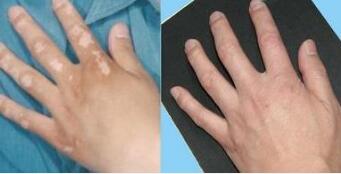 手部白癜风在治疗时会有什么变化