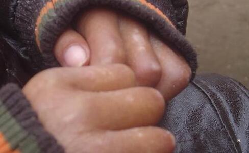 手上的小白斑会不会是白癜风