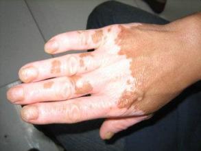 手上的白癜风可以使用偏方治疗吗