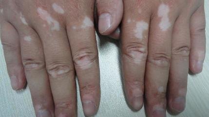 手部长了白斑症状患者该怎么对待