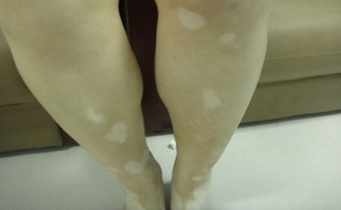 孩子腿上的白斑是怎么回事