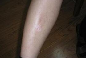 初期腿部白癜风有哪些症状表现