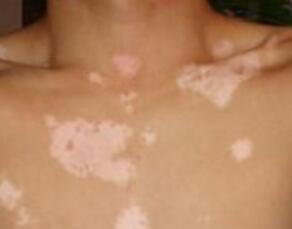 喝药治疗白癜风没效果该怎么办