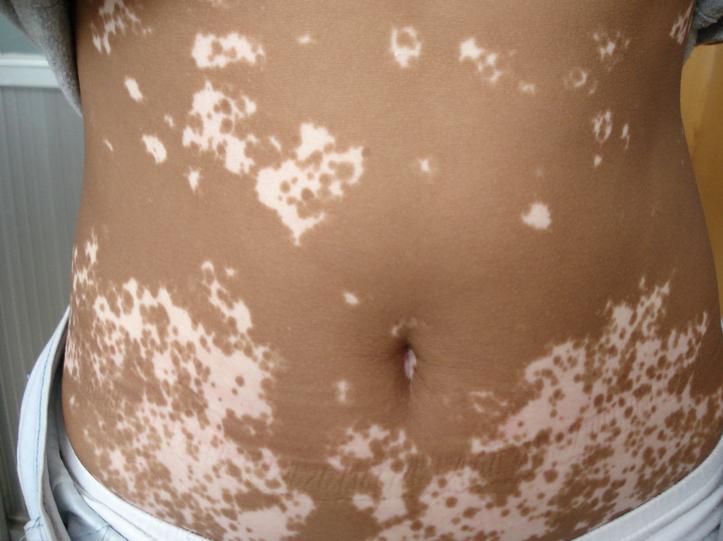 腰部白癜风不及时治疗会有哪些后果