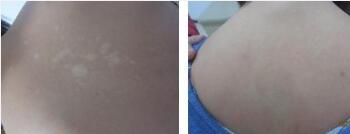 腰部白癜风病情该如何进行调节