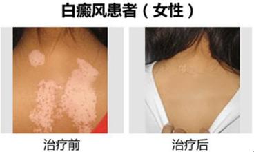 得了寻常型白癜风患者需要注意什么
