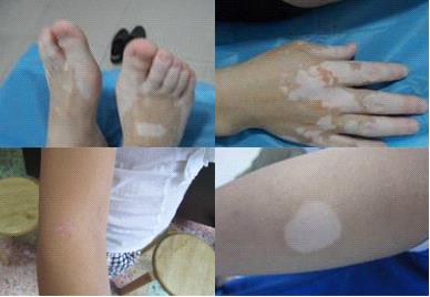 很多白癜风患者不知道的事情