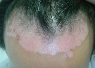 毛囊型白癜风应该如何有效治疗