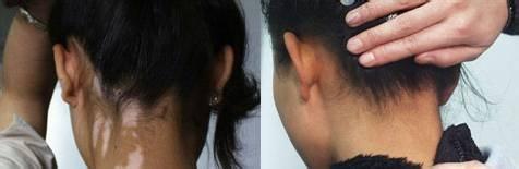 治疗毛囊型白癜风需要注意什么