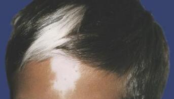 患者为什么会患上毛囊型白癜风