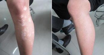 患者如何有效治疗肢端型白癜风