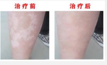 患者到底该怎么治疗肢端型白癜风呢
