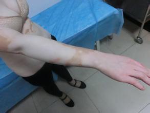 治疗节段型白癜风需要多少费用