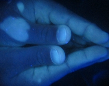 使用伍德灯诊断白斑是如何分辨的