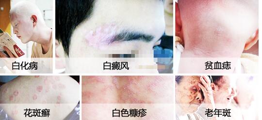 患者如何通过颜色诊断白癜风病症