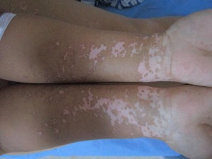 手部白癜风症状表现有什么