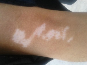 手部白癜风的症状都有哪些