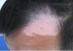 头部白癜风要怎么治疗