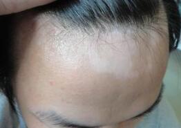 头部出现白癜风会有什么症状