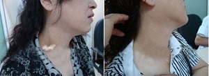 颈部患有白癜风怎么治疗