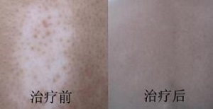 背部患上白癜风该怎么治疗