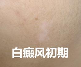 白癜风初期症状照片