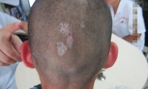 白癜风什么症状