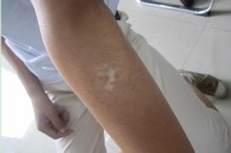 节段型白癜风患病病因