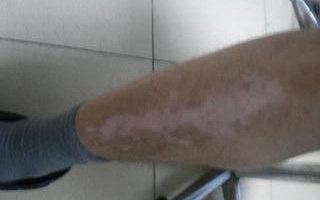 腿部白癜风早期的症状