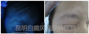 23岁女性眉部患白癜风10年余,在我院康复