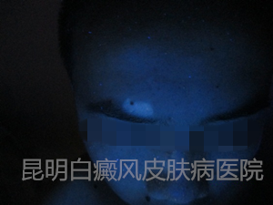 眉角白斑,在我院1个月康复