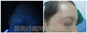 23岁女性眉部患白癜风10年余,在我院康复