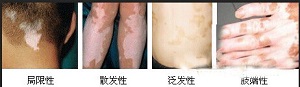 怎样预防寻常型白癜风