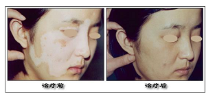 毛囊型白癜风早期怎么治疗