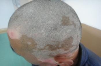 老年人白癜风的病因是什么