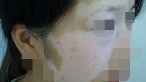脸部白癜风是哪些原因引起的