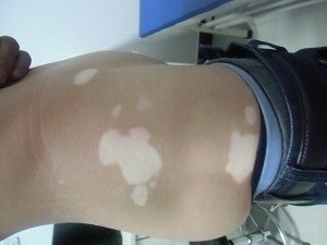 如何才能治好腰部白癜风