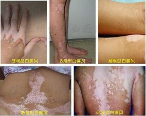 节段型白癜风的护理方法