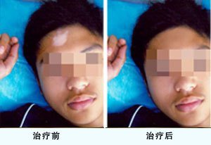 男性白癜风主要诱因有哪些