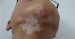 颈部患白癜风都有哪些危害