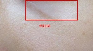 白癜风的基本症状都有哪些