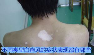 中老年人白癜风有什么症状