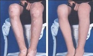 寻常型白癜风的症状表现