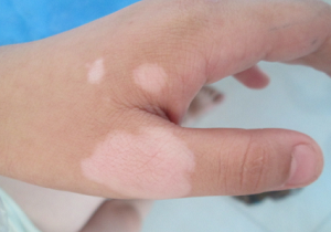 肢端型白癜风的治疗方法