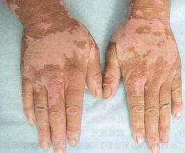 泛发型白斑有什么症状呢