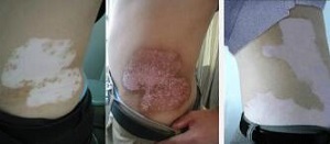 腰部白癜风照激光起泡怎么办